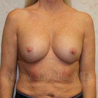 Abdominoplasty Tummy Tuck Before & After Gallery - Patient 1655444 - Before