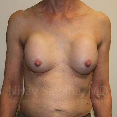 Fat Grafting to Face Before & After Gallery - Patient 1655447 - Before