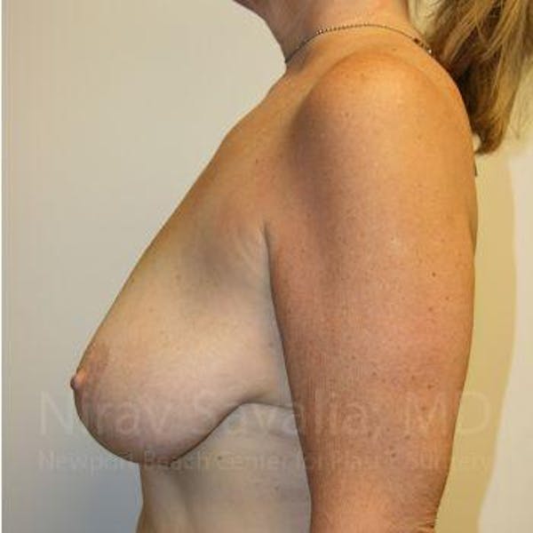 Male Breast Reduction Before & After Gallery - Patient 1655450 - Before