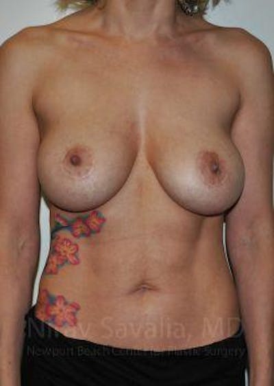 Breast Lift without Implants Before & After Gallery - Patient 1655455 - Before