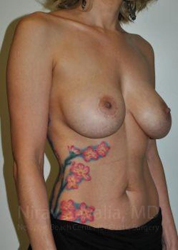 Breast Lift without Implants Before & After Gallery - Patient 1655455 - Before