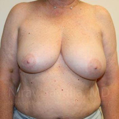 Male Breast Reduction Before & After Gallery - Patient 1655457 - Before