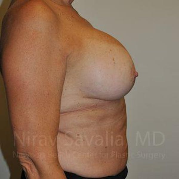 Male Breast Reduction Before & After Gallery - Patient 1655463 - Before