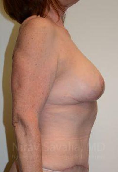 Breast Lift with Implants Before & After Gallery - Patient 1655458 - After