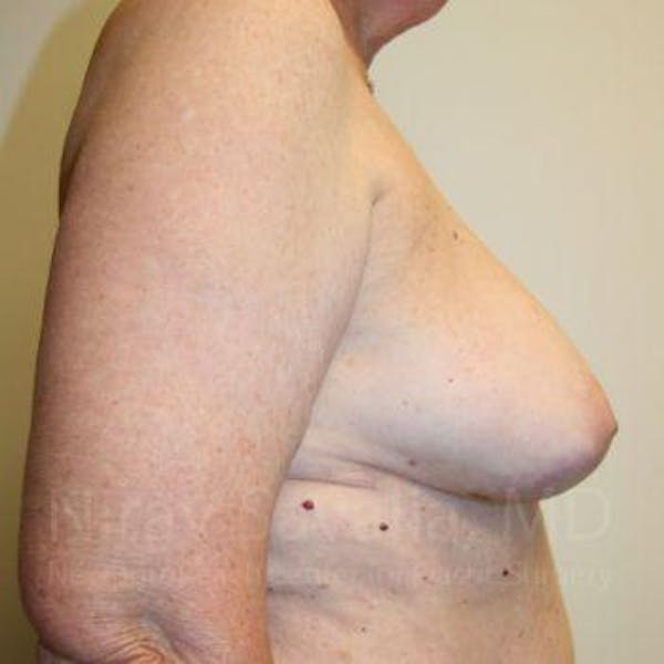 Male Breast Reduction Before & After Gallery - Patient 1655457 - Before