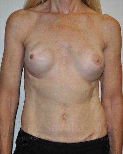 Fat Grafting to Face Before & After Gallery - Patient 1655466 - Before