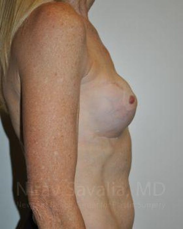 Fat Grafting to Face Before & After Gallery - Patient 1655466 - Before