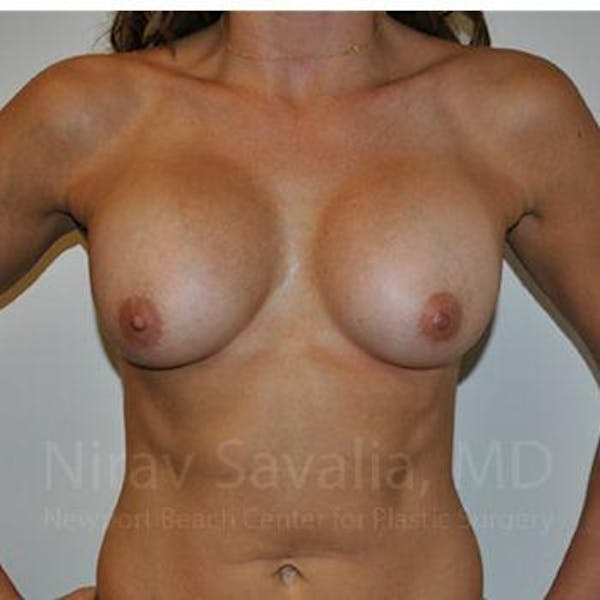 Male Breast Reduction Before & After Gallery - Patient 1655470 - Before