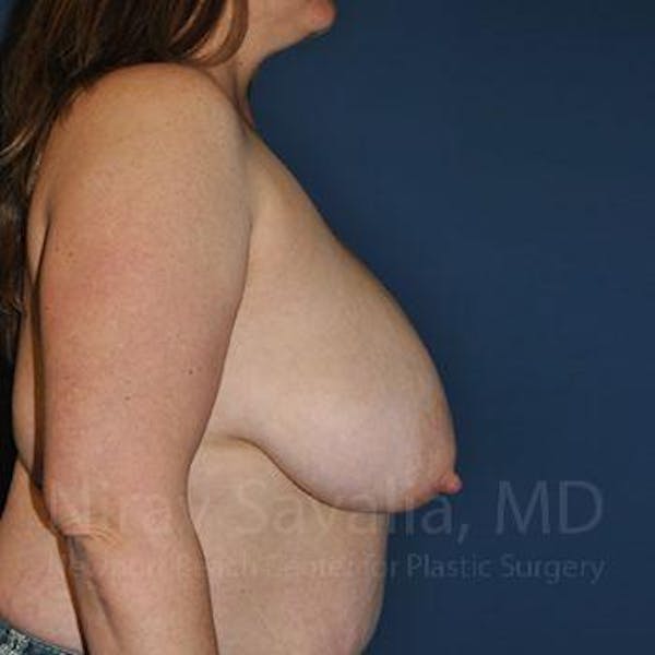 Fat Grafting to Face Before & After Gallery - Patient 1655476 - Before