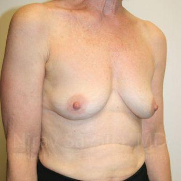 Male Breast Reduction Before & After Gallery - Patient 1655475 - Before