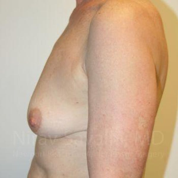 Male Breast Reduction Before & After Gallery - Patient 1655475 - Before