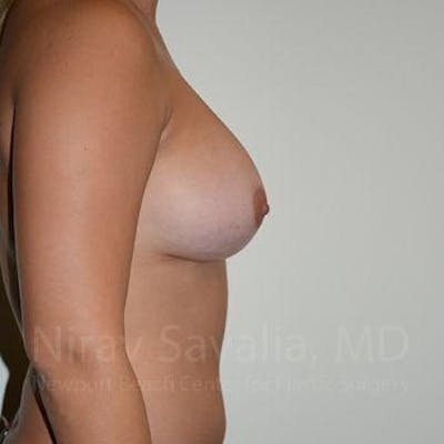 Male Breast Reduction Before & After Gallery - Patient 1655477 - After