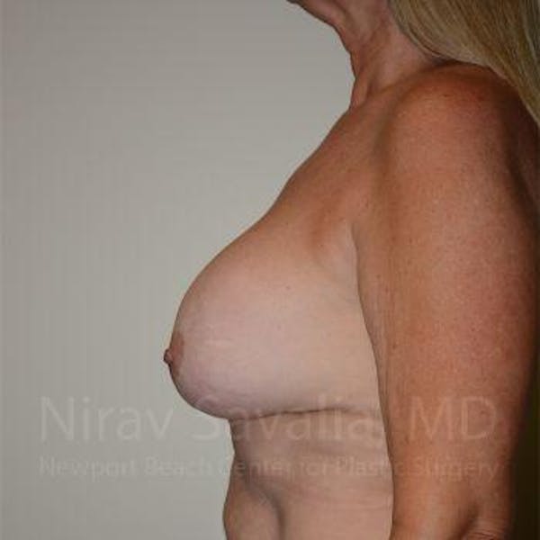 Male Breast Reduction Before & After Gallery - Patient 1655483 - Before