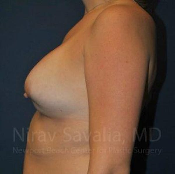 Male Breast Reduction Before & After Gallery - Patient 1655486 - Before