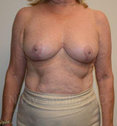 Mastectomy Reconstruction Before & After Gallery - Patient 1655496 - After