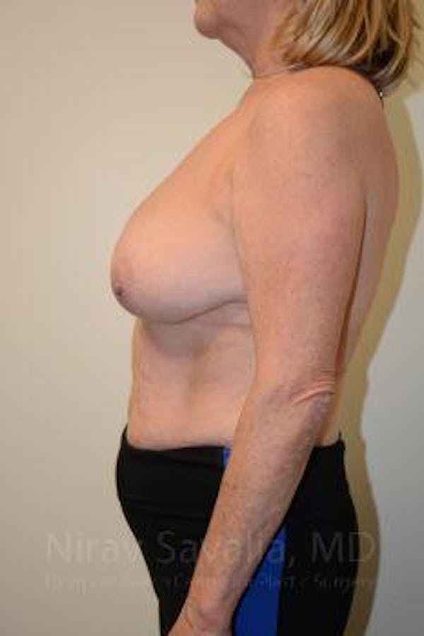 Mastectomy Reconstruction Before & After Gallery - Patient 1655496 - Before