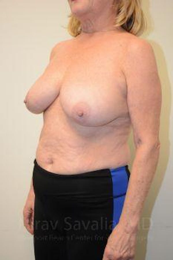 Mastectomy Reconstruction Before & After Gallery - Patient 1655496 - Before