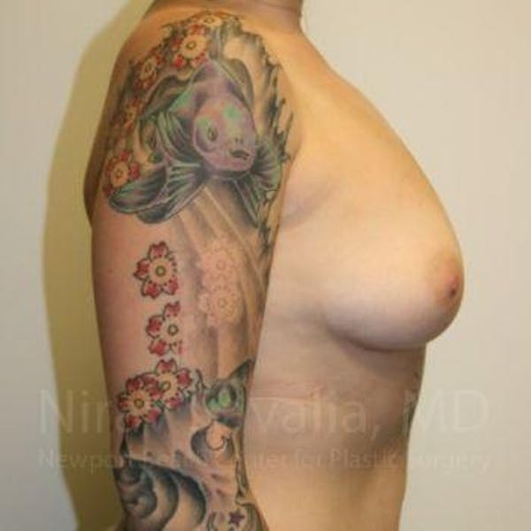 Breast Reduction Before & After Gallery - Patient 1655500 - Before