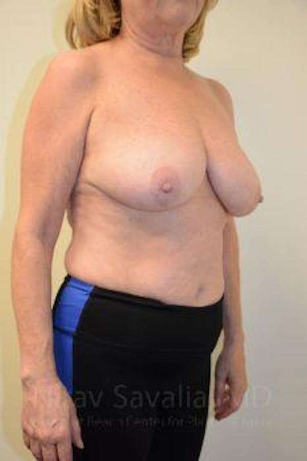 Mastectomy Reconstruction Before & After Gallery - Patient 1655496 - Before