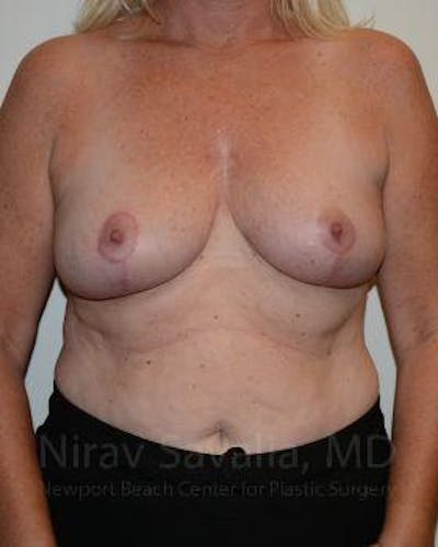 Oncoplastic Reconstruction Before & After Gallery - Patient 1655499 - After