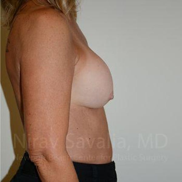 Male Breast Reduction Before & After Gallery - Patient 1655503 - Before