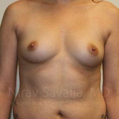 Male Breast Reduction Before & After Gallery - Patient 1655506 - Before