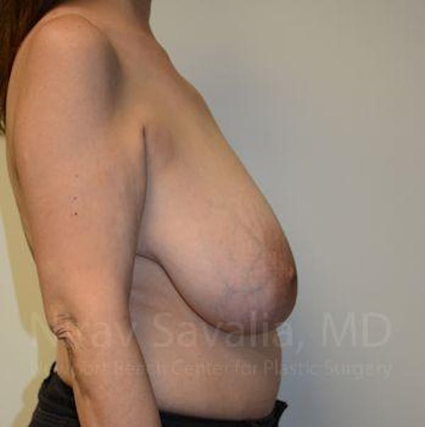 Male Breast Reduction Before & After Gallery - Patient 1655505 - Before