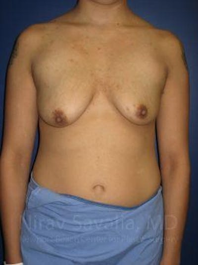 Male Breast Reduction Before & After Gallery - Patient 1655508 - Before