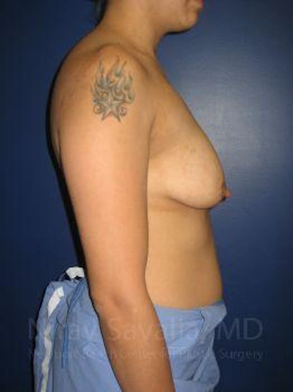 Male Breast Reduction Before & After Gallery - Patient 1655508 - Before