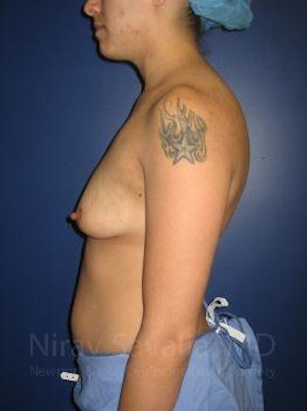 Male Breast Reduction Before & After Gallery - Patient 1655508 - Before