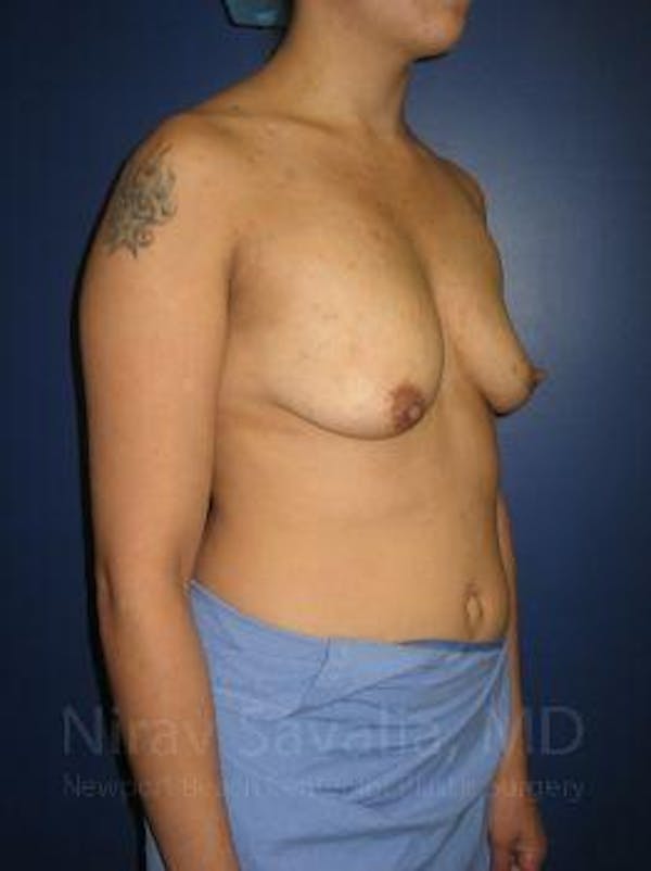 Male Breast Reduction Before & After Gallery - Patient 1655508 - Before