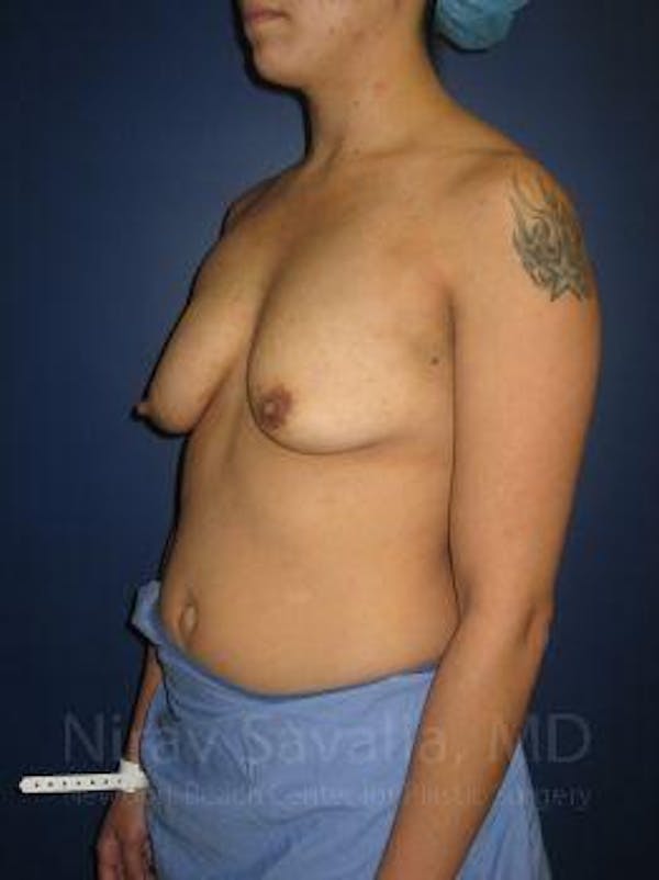 Male Breast Reduction Before & After Gallery - Patient 1655508 - Before