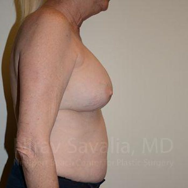 Male Breast Reduction Before & After Gallery - Patient 1655513 - Before