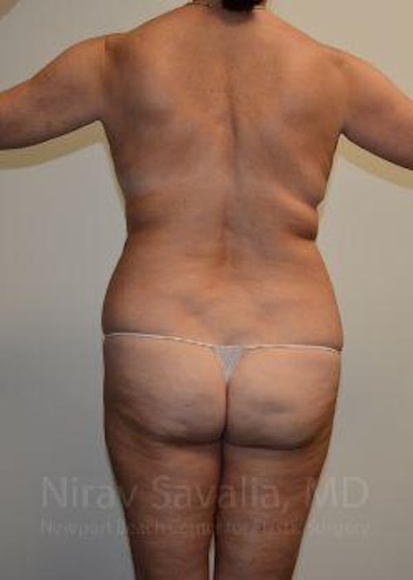 Breast Lift without Implants Before & After Gallery - Patient 1655515 - Before