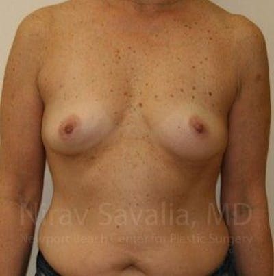 Male Breast Reduction Before & After Gallery - Patient 1655519 - Before