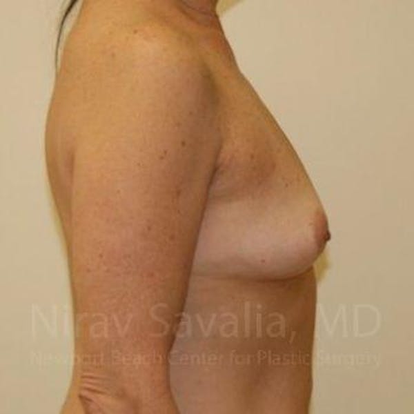 Male Breast Reduction Before & After Gallery - Patient 1655519 - Before