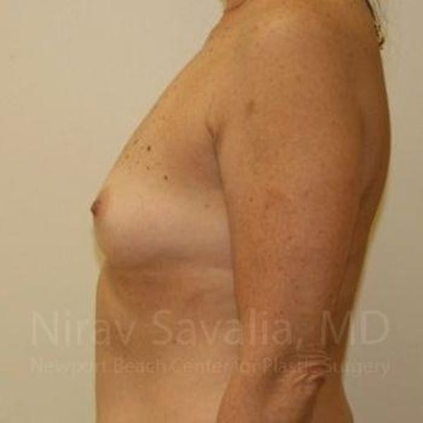 Male Breast Reduction Before & After Gallery - Patient 1655519 - Before