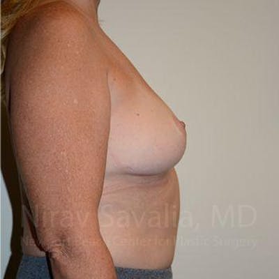 Male Breast Reduction Before & After Gallery - Patient 1655523 - After