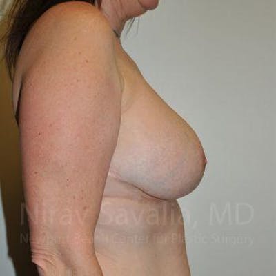 Male Breast Reduction Before & After Gallery - Patient 1655526 - After