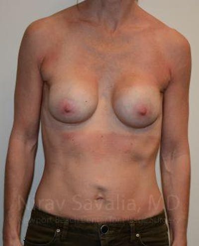 Fat Grafting to Face Before & After Gallery - Patient 1655536 - Before