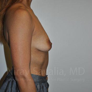 Abdominoplasty Tummy Tuck Before & After Gallery - Patient 1655537 - Before