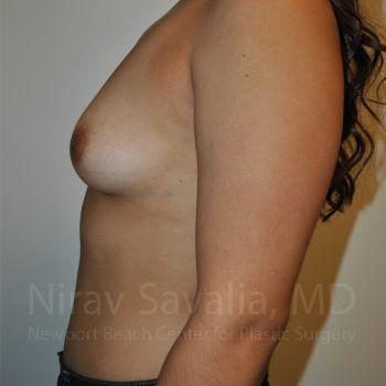 Male Breast Reduction Before & After Gallery - Patient 1655544 - Before