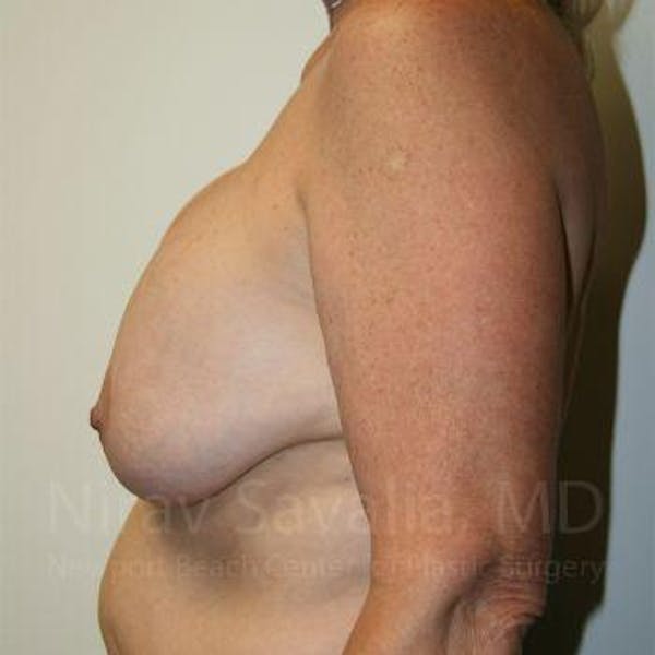 Male Breast Reduction Before & After Gallery - Patient 1655545 - Before