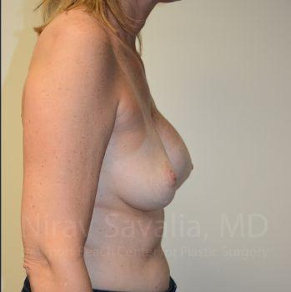 Male Breast Reduction Before & After Gallery - Patient 1655547 - Before