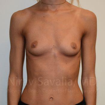 Liposuction Before & After Gallery - Patient 1655548 - Before