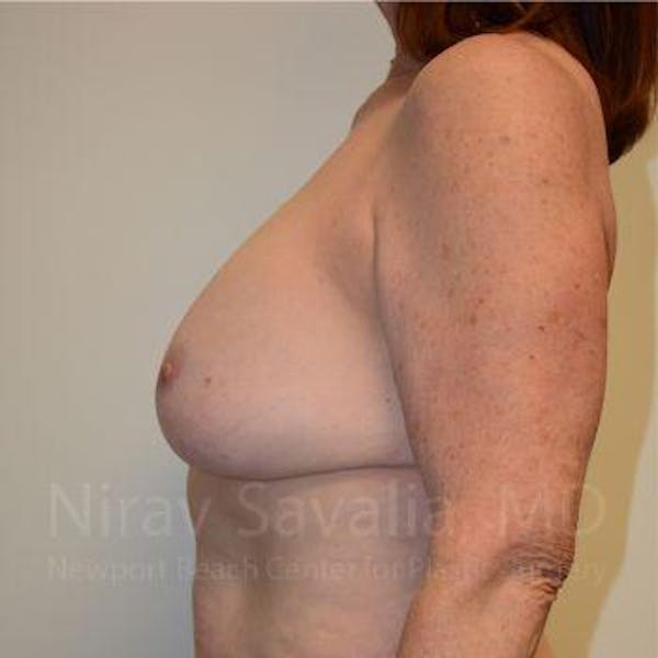 Male Breast Reduction Before & After Gallery - Patient 1655549 - Before