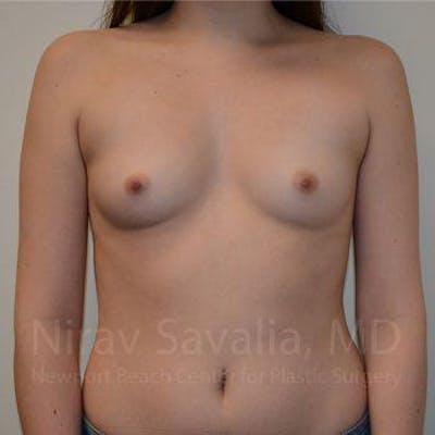 Male Breast Reduction Before & After Gallery - Patient 1655555 - Before