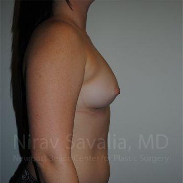 Male Breast Reduction Before & After Gallery - Patient 1655559 - Before