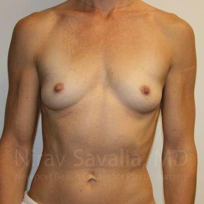 Male Breast Reduction Before & After Gallery - Patient 1655561 - Before