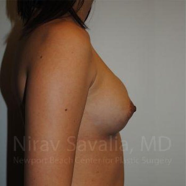 Body Contouring after Weight Loss Before & After Gallery - Patient 1655564 - Before